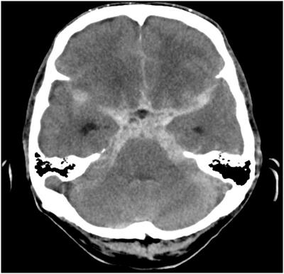 A rare case of Pseudomonas putida ventriculitis in intensive care unit: A case report